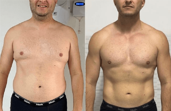 Antes e depois de paciente homem, vista frontal