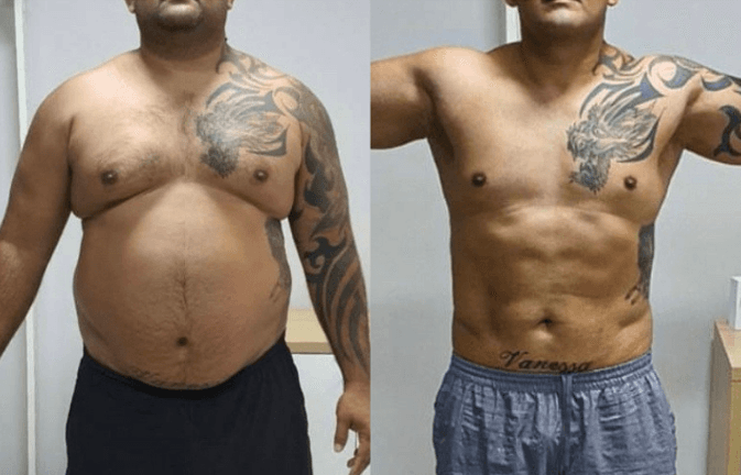 Antes e depois de paciente homem, vista frontal