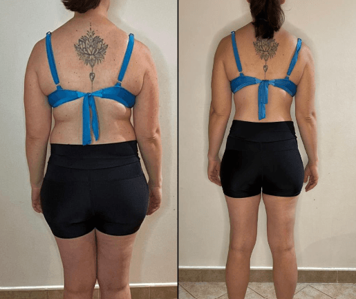 Antes e depois de paciente, vista de costas