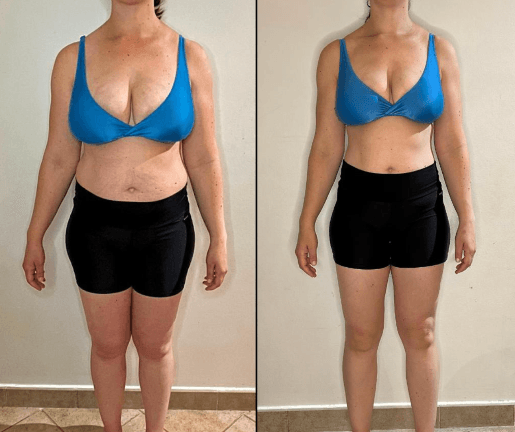Antes e depois de paciente, vista frontal