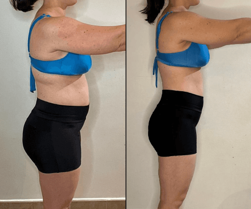 Antes e depois de paciente, vista lateral